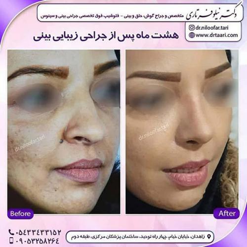 جراحی-بینی-273