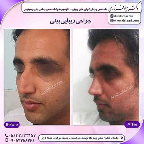 جراحی-بینی-274