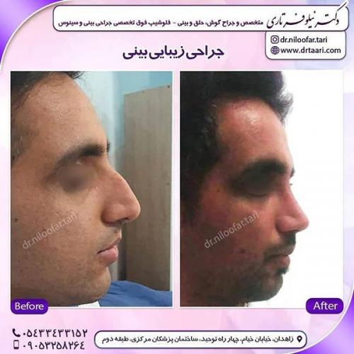 جراحی-بینی-275