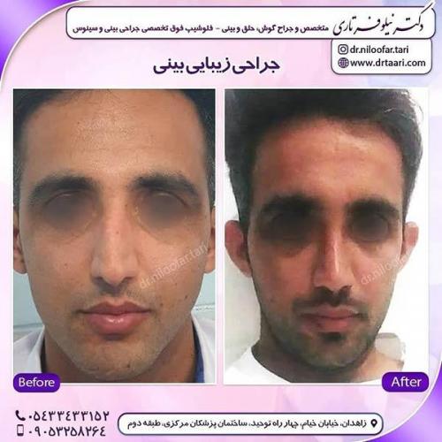 جراحی-بینی-276