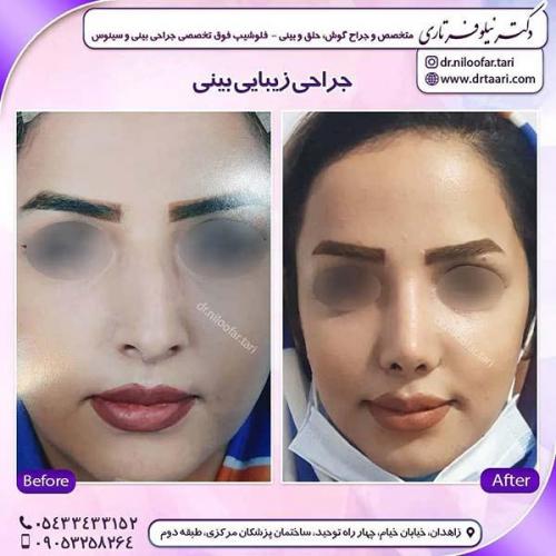 جراحی-بینی-277