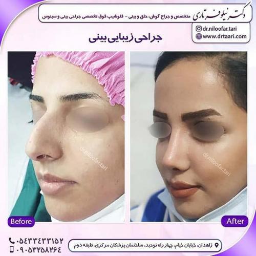 جراحی-بینی-279