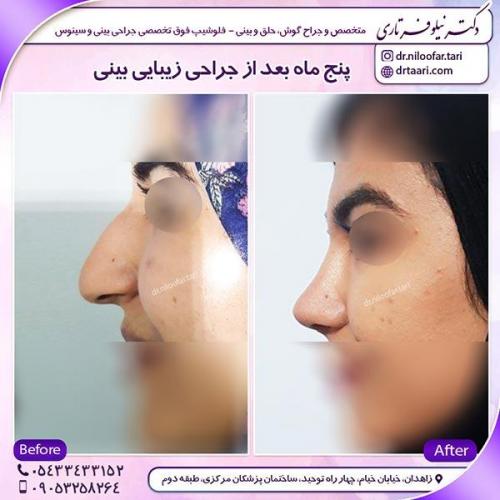 جراحی-بینی-28