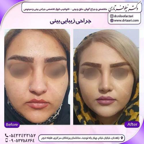 جراحی-بینی-280