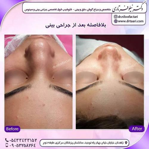 جراحی-بینی-283