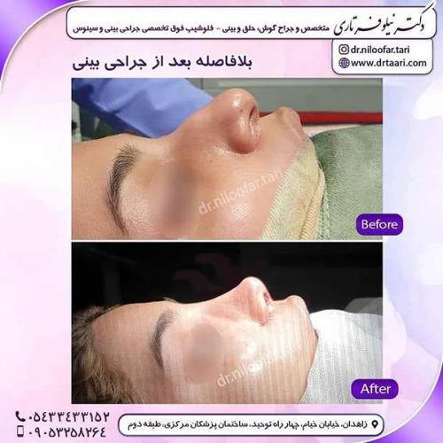 جراحی-بینی-284