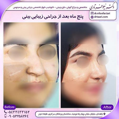 جراحی-بینی-30