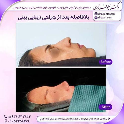 جراحی-بینی-31