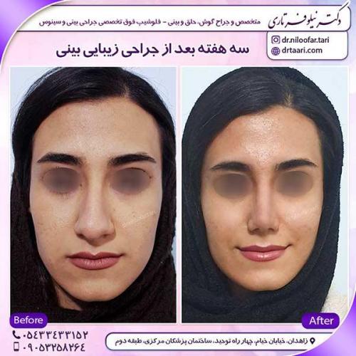جراحی-بینی-32