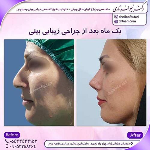 جراحی-بینی-33
