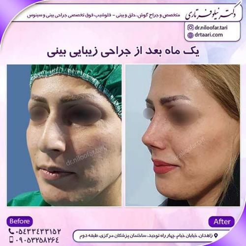 جراحی-بینی-35