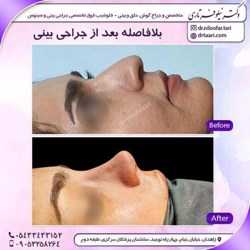 جراحی-بینی-36