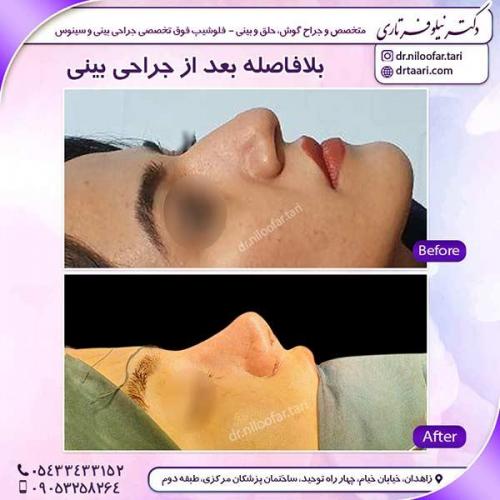 جراحی-بینی-37