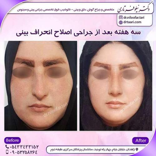 جراحی-بینی-38