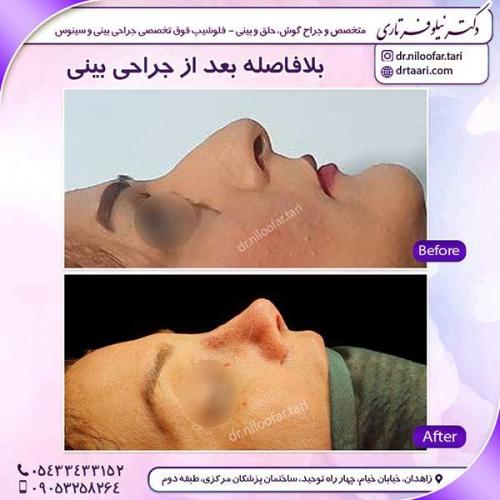 جراحی-بینی-39