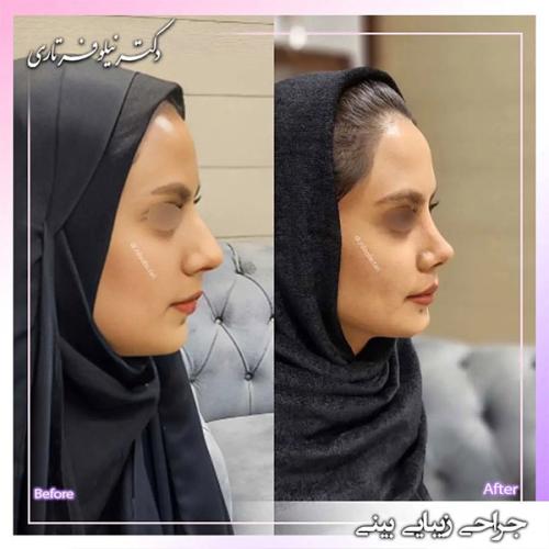 جراحی-بینی-399