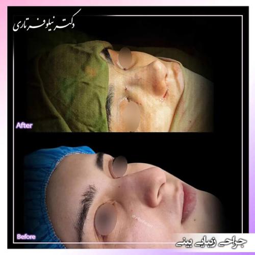 جراحی-بینی-403