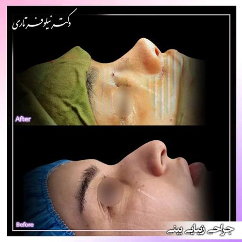 جراحی-بینی-404