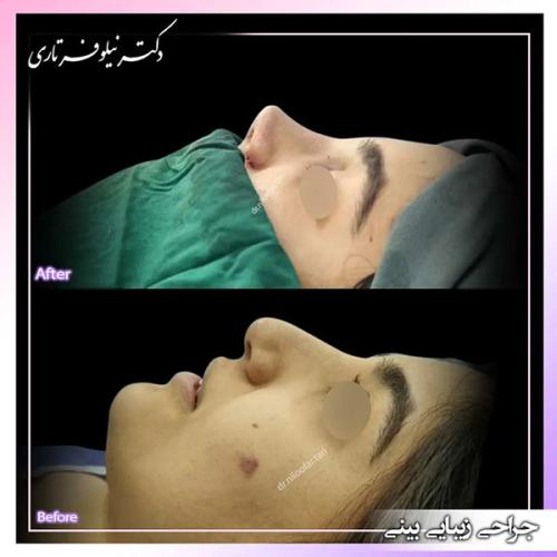 جراحی-بینی-405