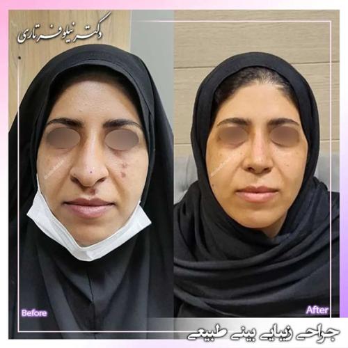 جراحی-بینی-406