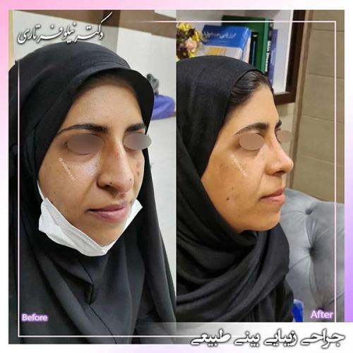 جراحی-بینی-407