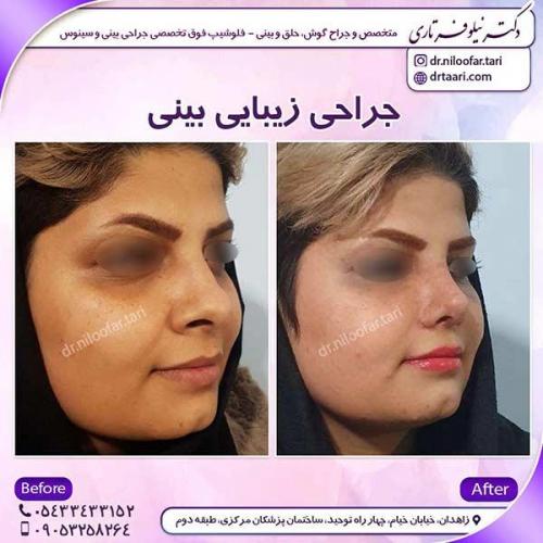 جراحی-بینی-41