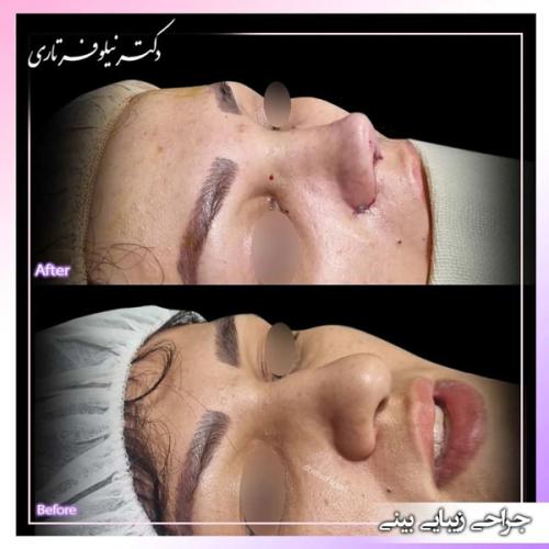 جراحی-بینی-410 (1)