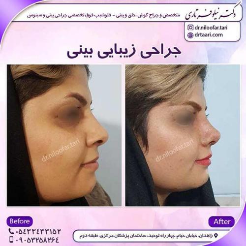 جراحی-بینی-42