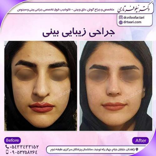 جراحی-بینی-44