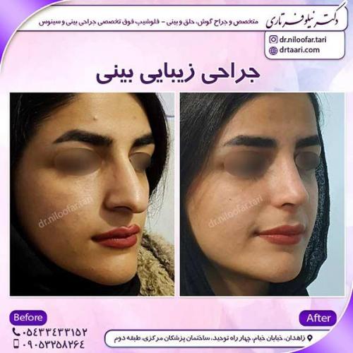 جراحی-بینی-45