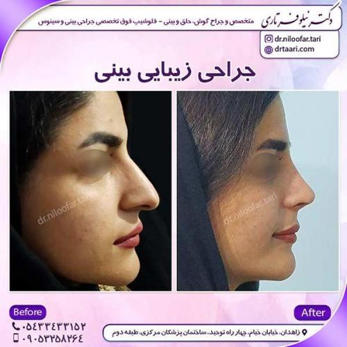 جراحی-بینی-46