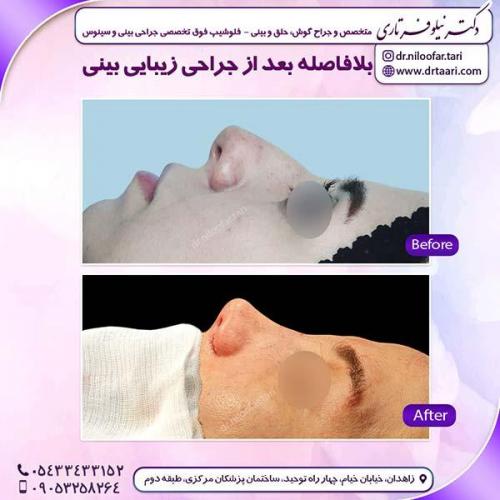 جراحی-بینی-47