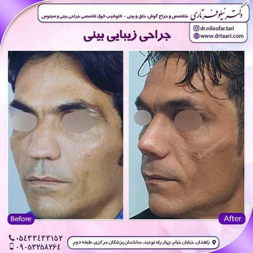 جراحی-بینی-50