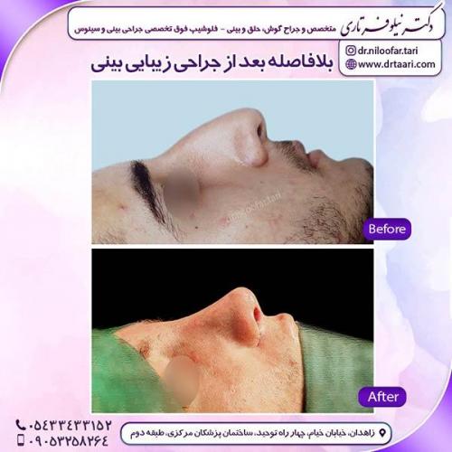 جراحی-بینی-51