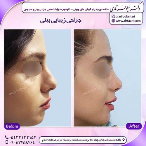 جراحی-بینی-53