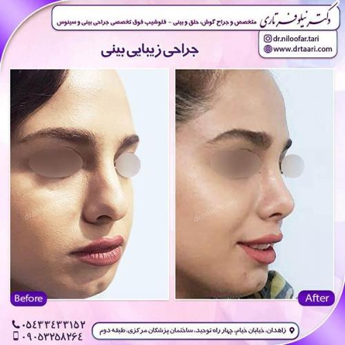 جراحی-بینی-54