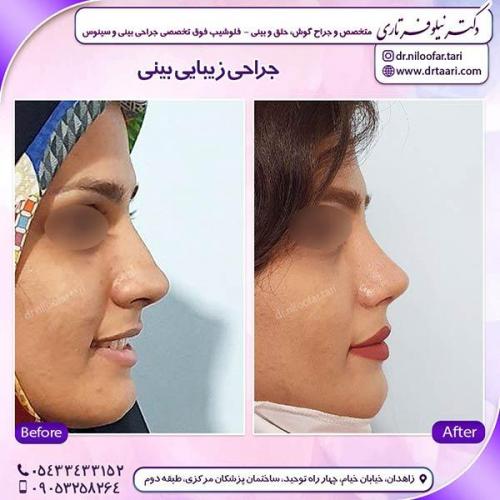 جراحی-بینی-55