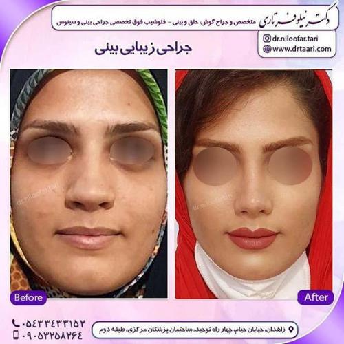 جراحی-بینی-56