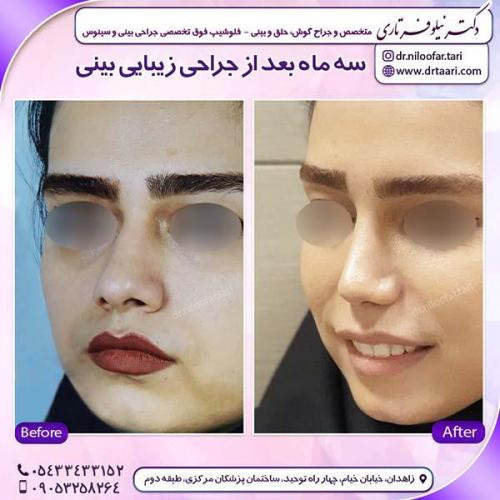 جراحی-بینی-57