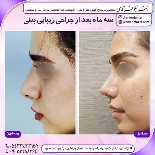 جراحی-بینی-58