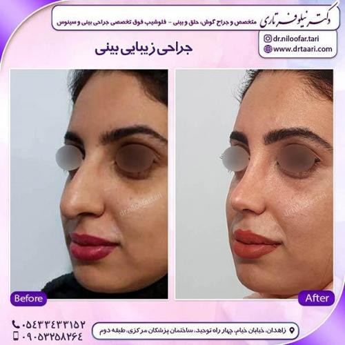 جراحی-بینی-60