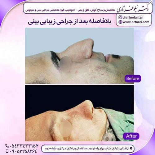 جراحی-بینی-63