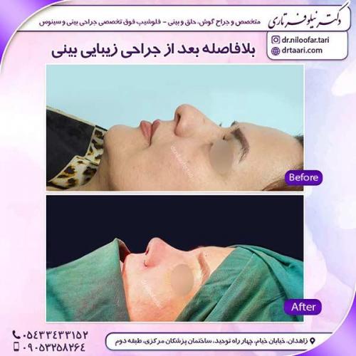 جراحی-بینی-64