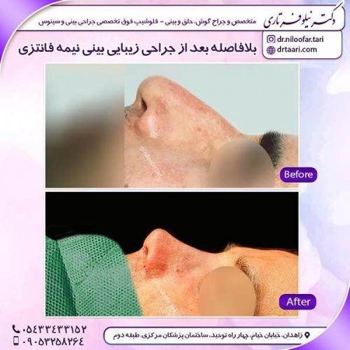 جراحی-بینی-65