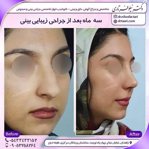 جراحی-بینی-66