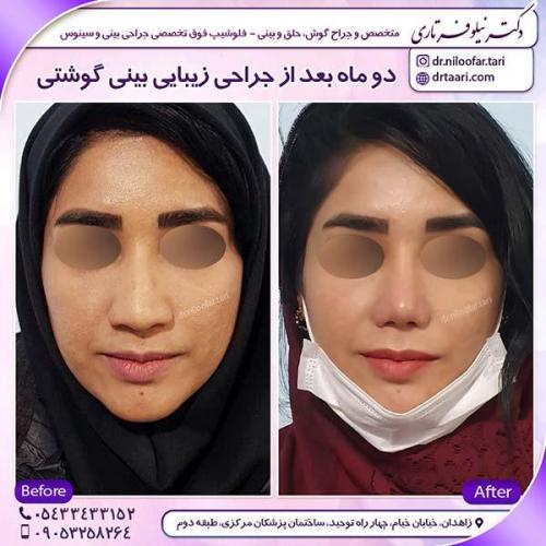 جراحی-بینی-68