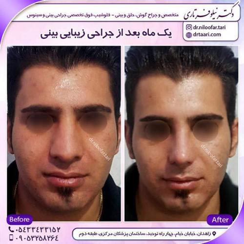 جراحی-بینی-7