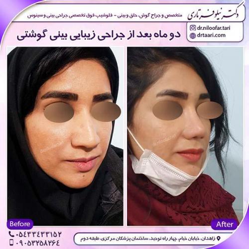 جراحی-بینی-70