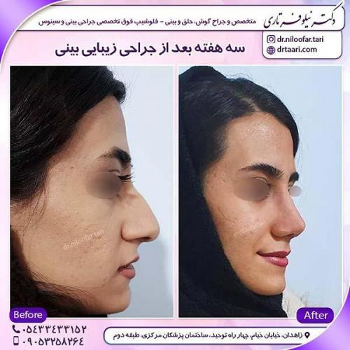 جراحی-بینی-71