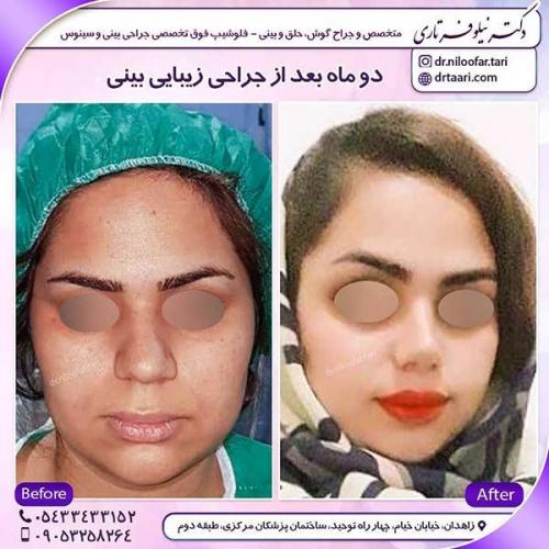 جراحی-بینی-72